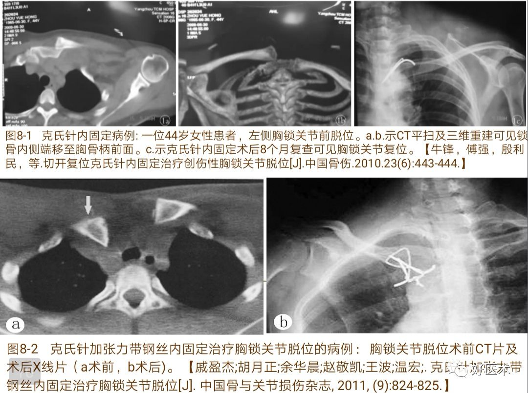 胸锁关节脱位的诊治技巧，系统详解！