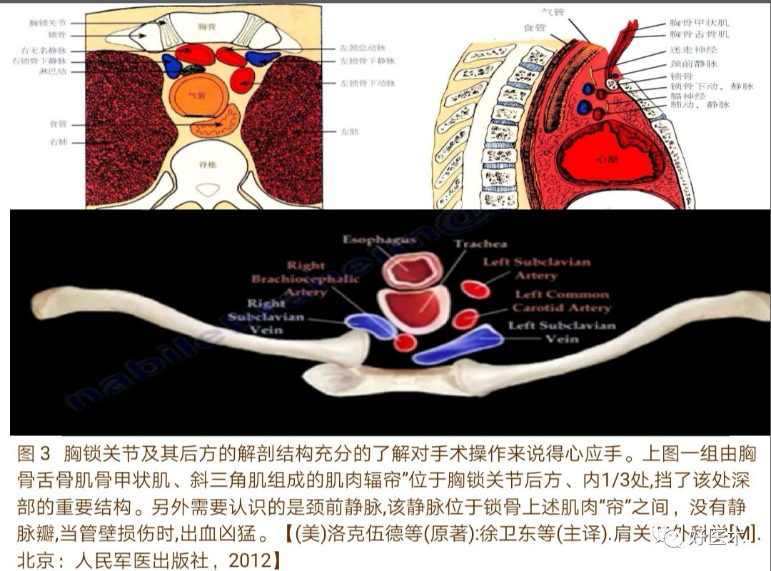 胸锁关节脱位的诊治技巧，系统详解！