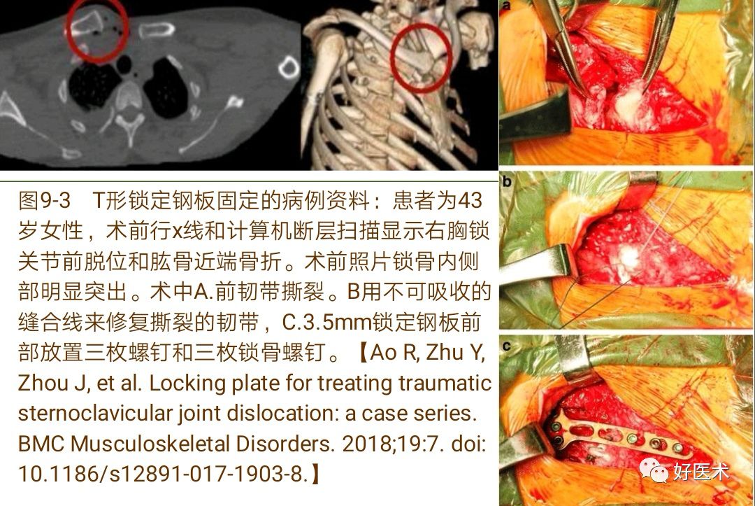 胸锁关节脱位的诊治技巧，系统详解！