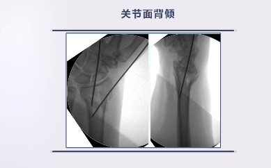 桡骨远端骨折的手术治疗要点，这篇帮你整理好了！
