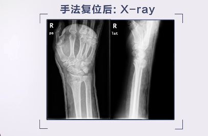 桡骨远端骨折的手术治疗要点，这篇帮你整理好了！