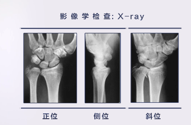 桡骨远端骨折的手术治疗要点，这篇帮你整理好了！