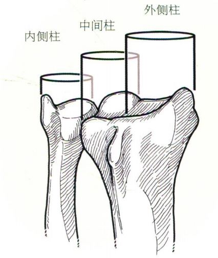 桡骨远端骨折的手术治疗要点，这篇帮你整理好了！