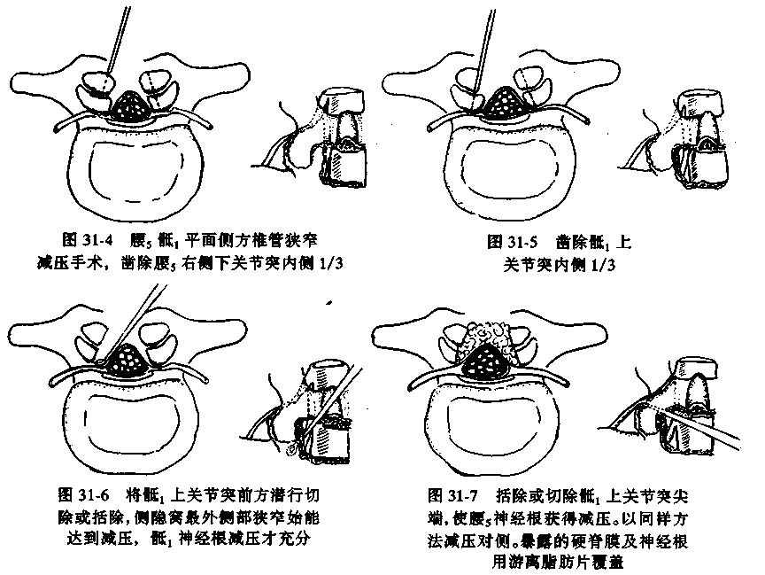 关于腰椎管狭窄症，这篇文章讲得太全面了！