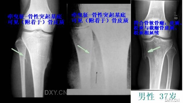 需要注意！这个“病”极易误诊为骨软骨瘤