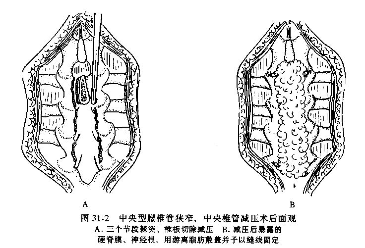 关于腰椎管狭窄症，这篇文章讲得太全面了！