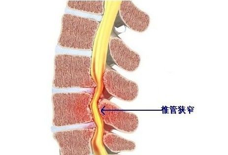 关于腰椎管狭窄症，这篇文章讲得太全面了！