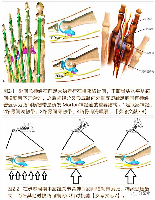 引起前足痛的Morton神经瘤，你了解吗？