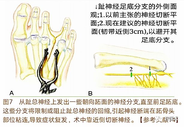 引起前足痛的Morton神经瘤，你了解吗？