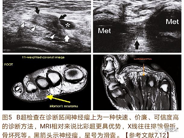 引起前足痛的Morton神经瘤，你了解吗？