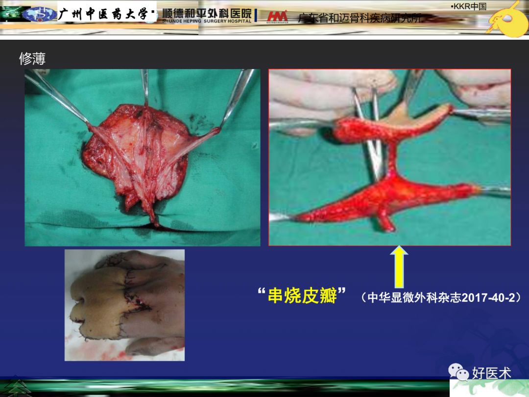 骨科创面修复，你是否忽视了“注重供区美观”？