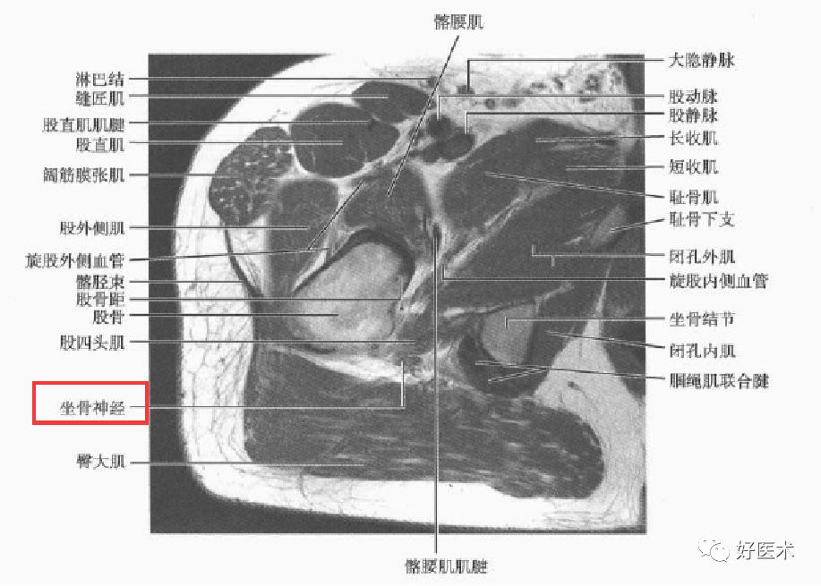 关于梨状肌综合征，你全都了解吗？