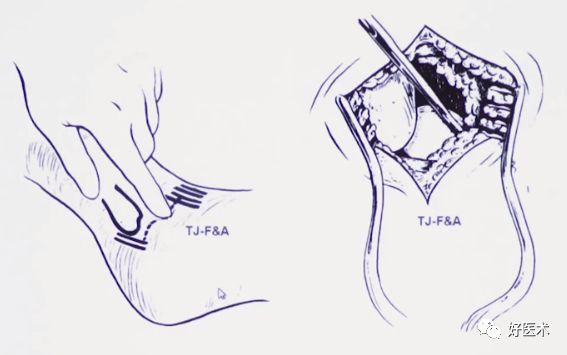 跟骨骨折如何选择手术入路及内固定？看看这篇！