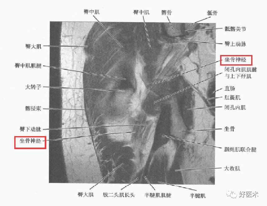 关于梨状肌综合征，你全都了解吗？