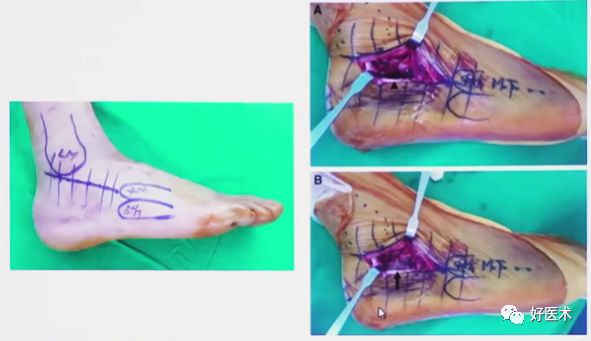跟骨骨折如何选择手术入路及内固定？看看这篇！