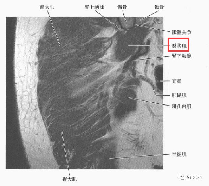 关于梨状肌综合征，你全都了解吗？