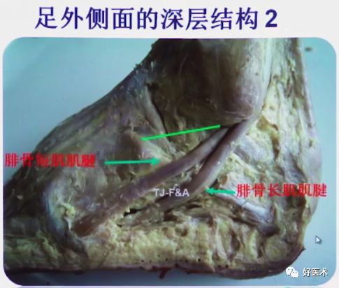 跟骨骨折如何选择手术入路及内固定？看看这篇！