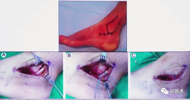 跟骨骨折如何选择手术入路及内固定？看看这篇！
