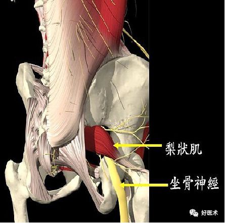 关于梨状肌综合征，你全都了解吗？