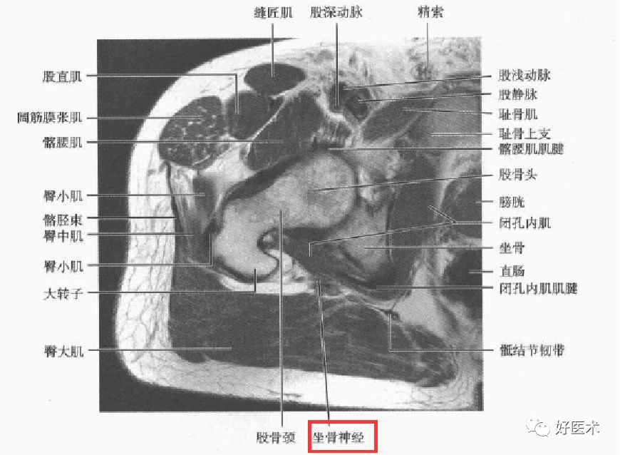 关于梨状肌综合征，你全都了解吗？