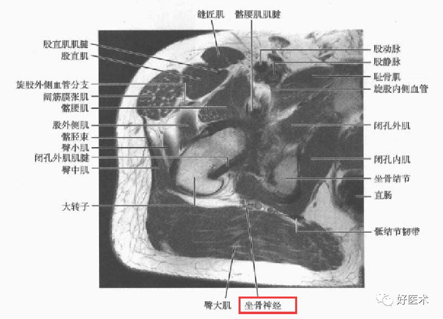 关于梨状肌综合征，你全都了解吗？