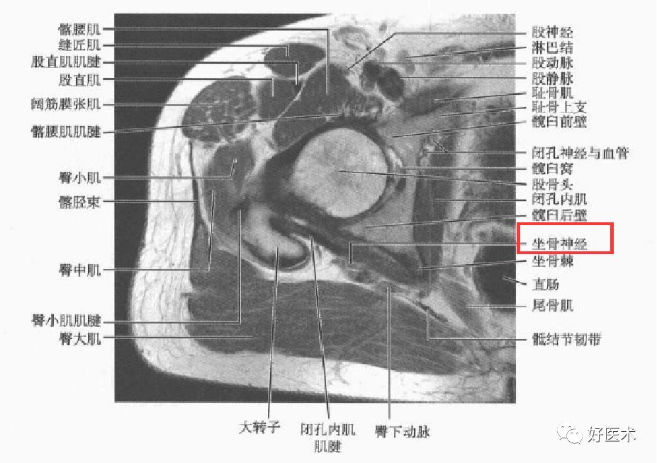 关于梨状肌综合征，你全都了解吗？