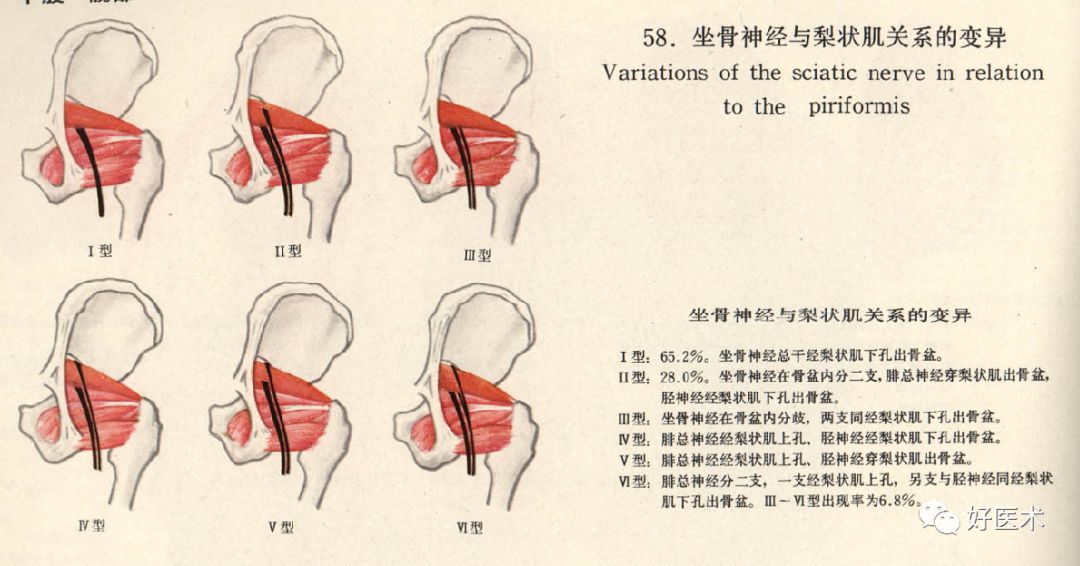 关于梨状肌综合征，你全都了解吗？