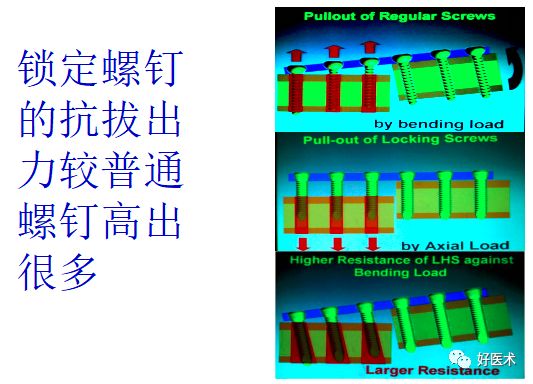 关于锁定钢板，这篇文章讲得太全面了！