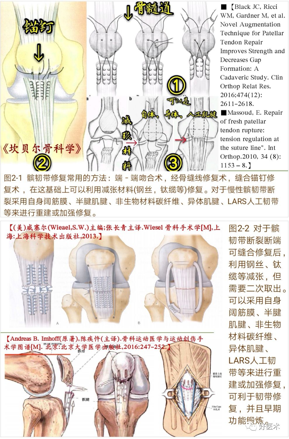 膝关节髌韧带断裂的诊治技巧，系统详解！