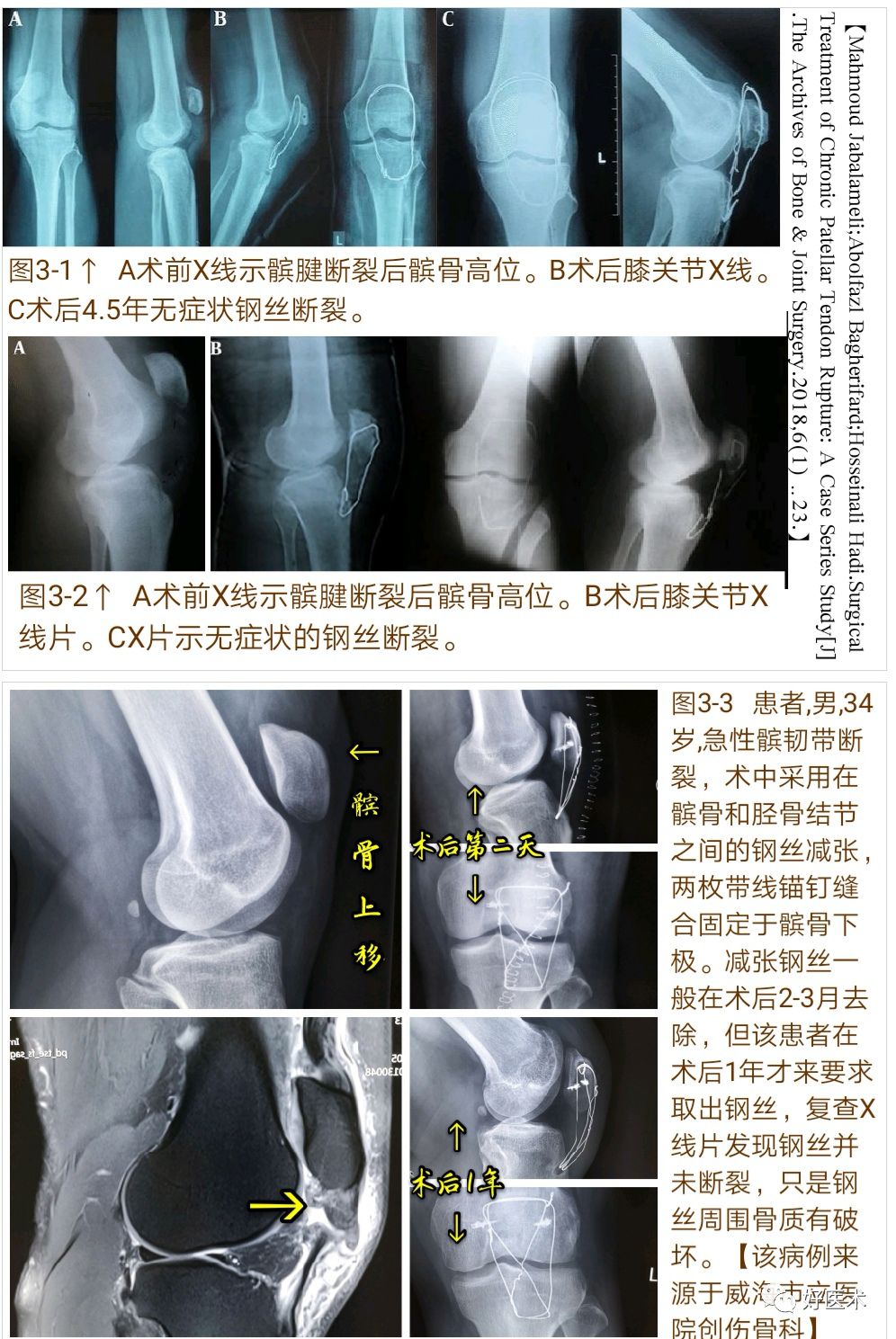 膝关节髌韧带断裂的诊治技巧，系统详解！