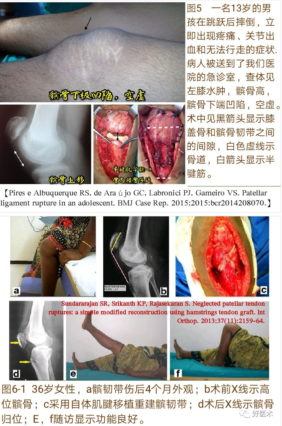 膝关节髌韧带断裂的诊治技巧，系统详解！