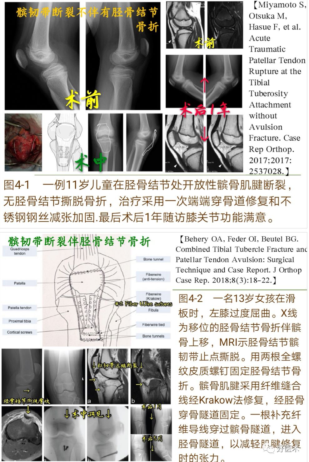 膝关节髌韧带断裂的诊治技巧，系统详解！