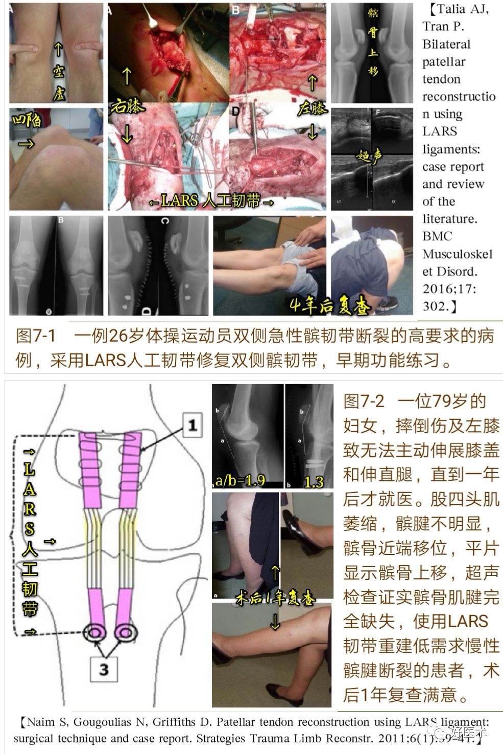 膝关节髌韧带断裂的诊治技巧，系统详解！