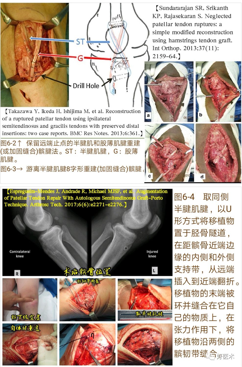 膝关节髌韧带断裂的诊治技巧，系统详解！