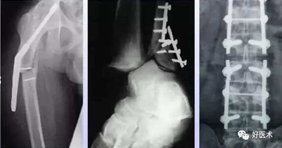 骨科内固定物断裂的原因，4张图就说明了！