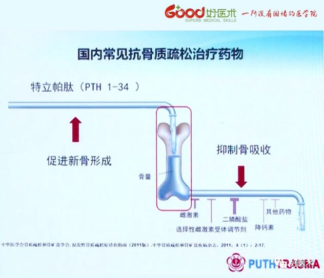 全面讲解！粗隆部骨折的围手术期处理