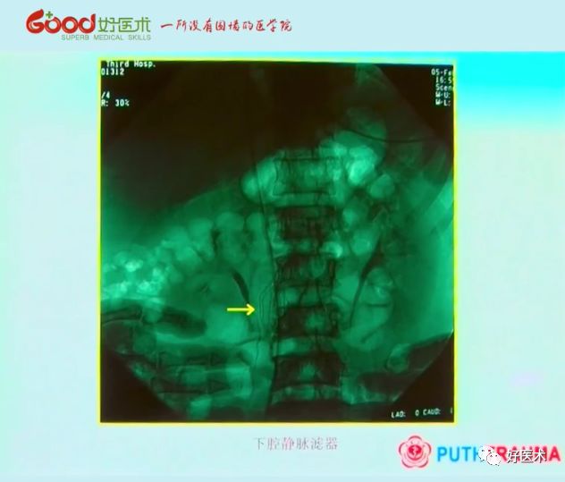 全面讲解！粗隆部骨折的围手术期处理