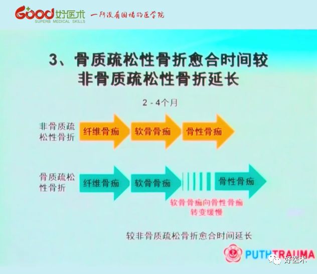 全面讲解！粗隆部骨折的围手术期处理