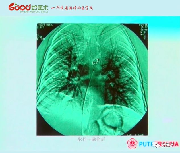 全面讲解！粗隆部骨折的围手术期处理