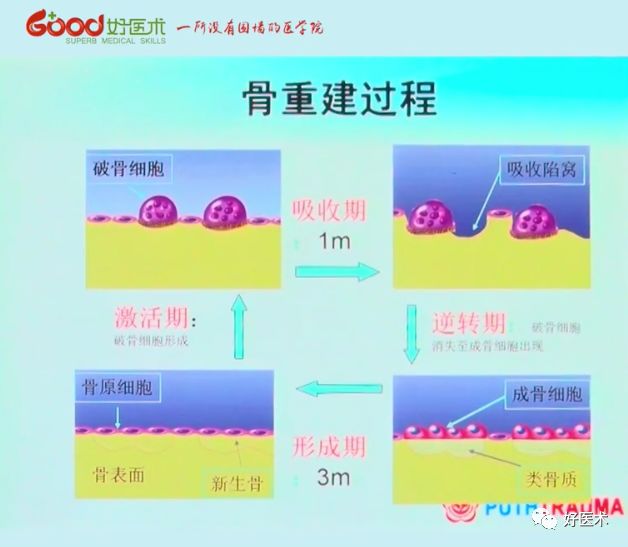 全面讲解！粗隆部骨折的围手术期处理