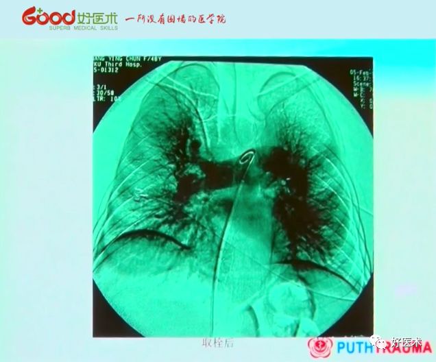 全面讲解！粗隆部骨折的围手术期处理