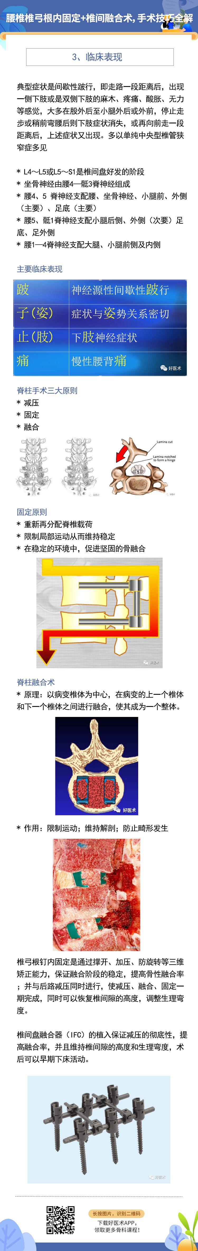 腰椎椎弓根内固定+椎间融合术，手术技巧全解析！