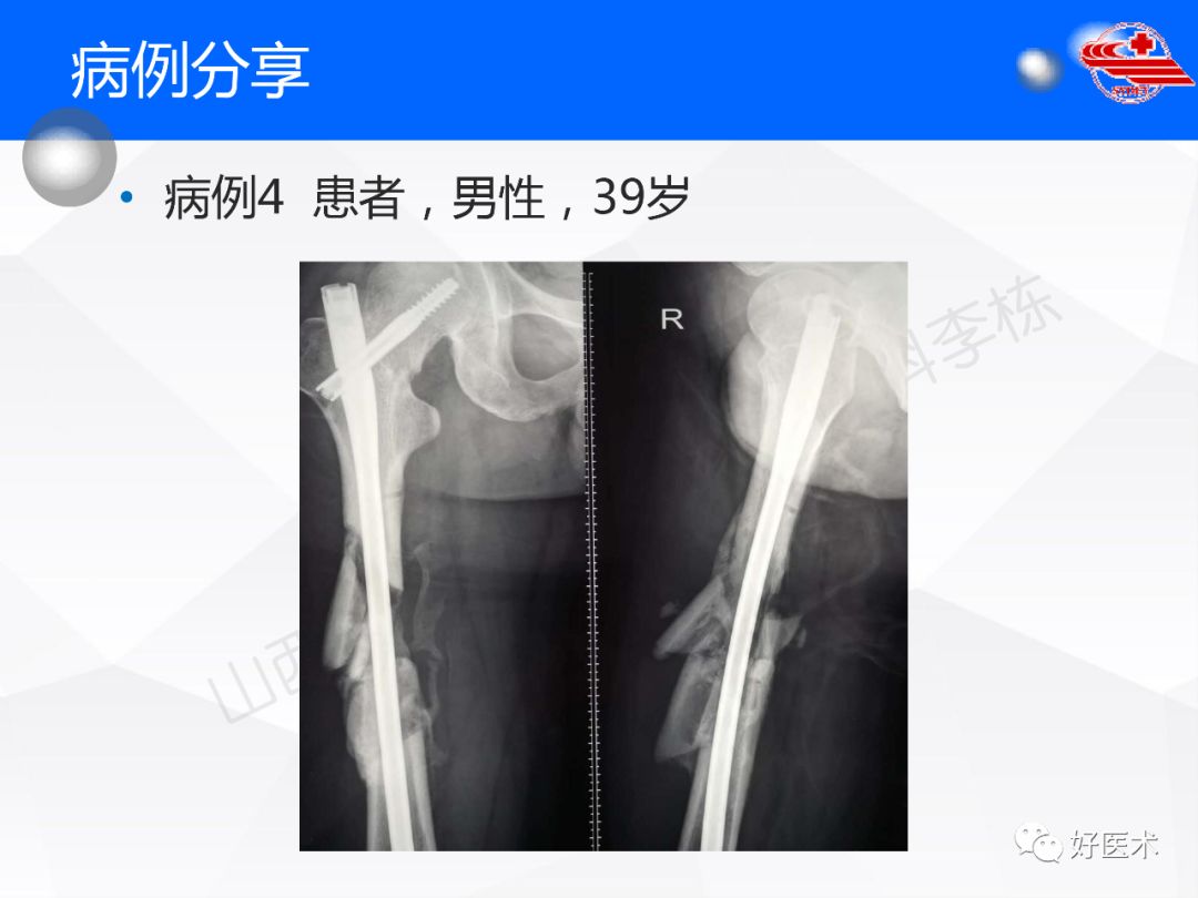 干货收藏帖！股骨干骨折髓内钉固定技巧