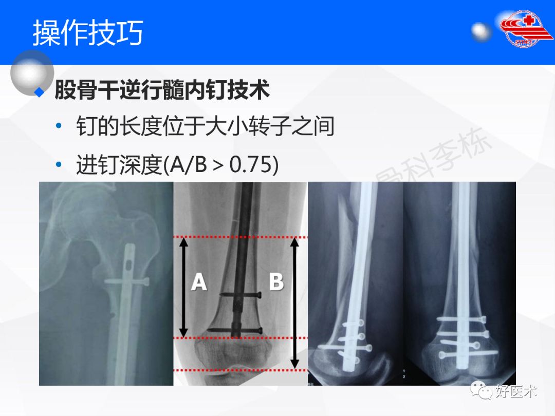 干货收藏帖！股骨干骨折髓内钉固定技巧