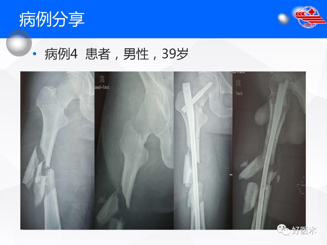 干货收藏帖！股骨干骨折髓内钉固定技巧