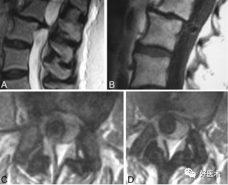 这种椎间盘突出症，90%骨科医生都没听说过！
