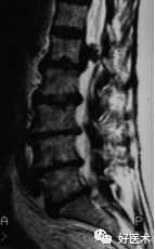 这种椎间盘突出症，90%骨科医生都没听说过！