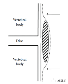 这种椎间盘突出症，90%骨科医生都没听说过！