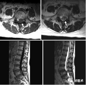 这种椎间盘突出症，90%骨科医生都没听说过！