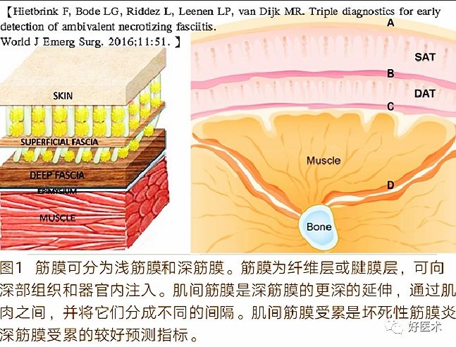 坏死性筋膜炎的诊治要点，看完这篇就够了！